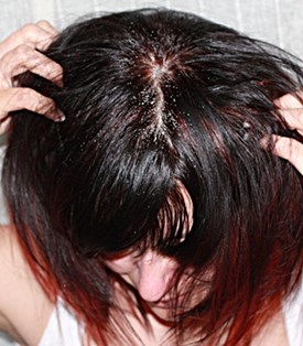 How to treat a really dry scalp